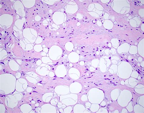 Pathology Outlines - Spindle cell / pleomorphic lipoma