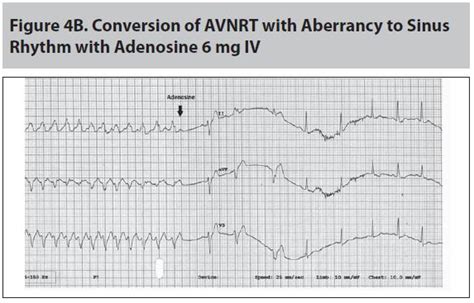 Supraventricular Tachycardia: A Review for the… | Relias Media