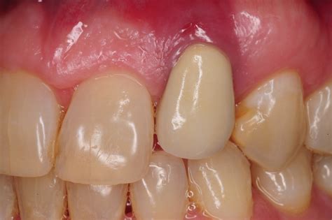 3. dental implant gum recession peri-implantitis infection poorly ...