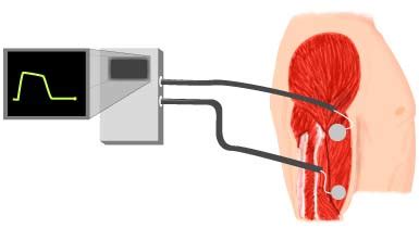 How Does Biofeedback Work for Muscle Pain? - Best Pain Doctor NYC