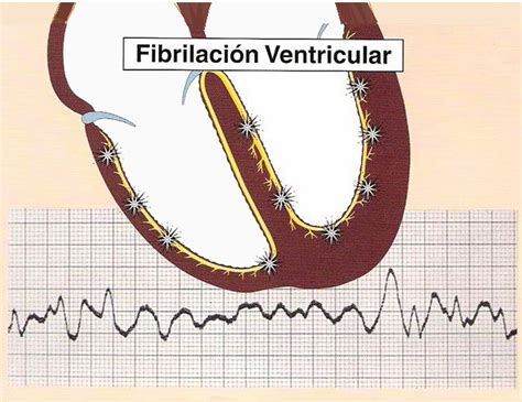 La fibrilación ventricular una muerte súbita - Venezblogger