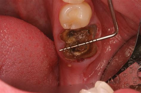 Hole After Molar Extraction - A Pictures Of Hole 2018