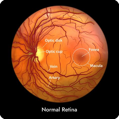 Retinal Disease - Retinal Vein Occlusion