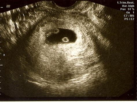 Ultrasound Pictures Of Twins At 5 Weeks - PictureMeta