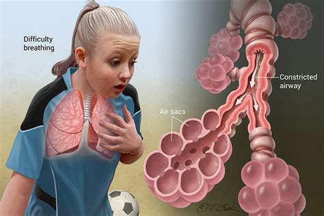 Asthma; types, risk factors, pathophysiology, signs and symptoms and ...