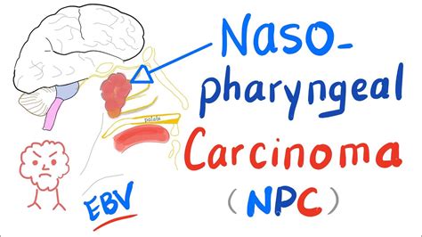 Nasopharyngeal Carcinoma Symptoms