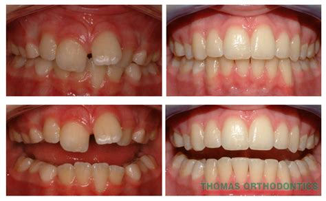 Before And After Gallery - Thomas OrthodonticsThomas Orthodontics