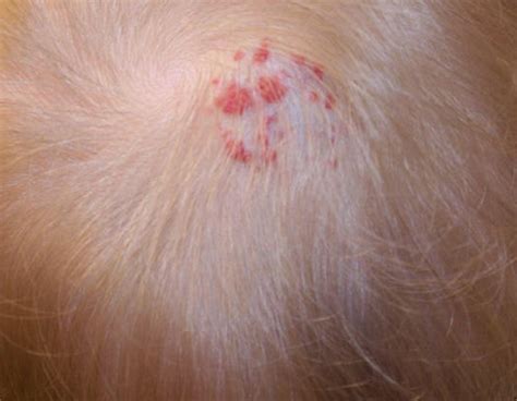 Itchy Bumps on Scalp - Treatment, Pictures, Symptoms, Causes