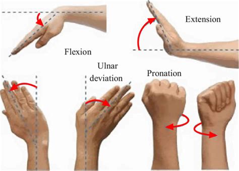 Ulnar deviation and ulnar drift definition and causes