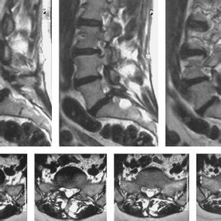 MRI and intraoperative images of a solitary Tarlov cyst at the right S2 ...