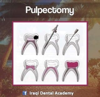 Pulpectomy With MTA Dental Care, 50% OFF