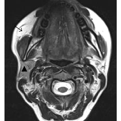 MRI scan of the parotid gland shows the unilateral agenesis of the... | Download Scientific Diagram