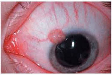 Conjunctival Neural, Xanthomatous, Fibrous, Myxomatous, and Lipomatous Tumors | Ento Key