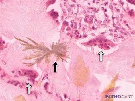 Histology Gout Tophus, Detail Image - DocCheck