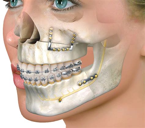 Oral-Maxillofacial Surgery | The Cavallini Chronicle | Dr. Marco Muñoz ...