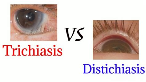 Difference between trichiasis and distichiasis - optometry club - YouTube