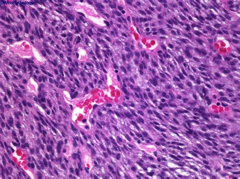 Webpathology.com: A Collection of Surgical Pathology Images