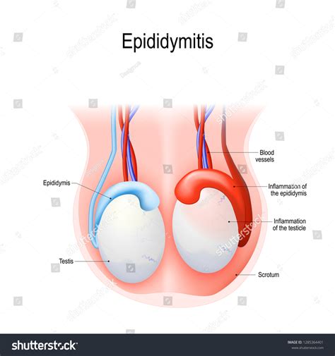 177 imágenes de Epididymitis - Imágenes, fotos y vectores de stock | Shutterstock