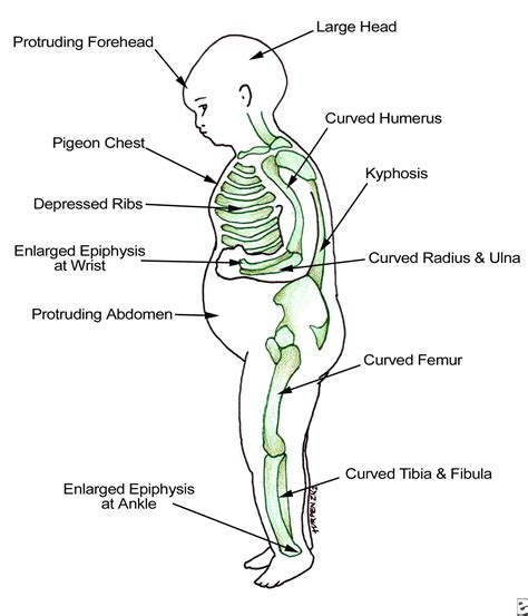 Hypophosphatemic Rickets | Bone and Spine