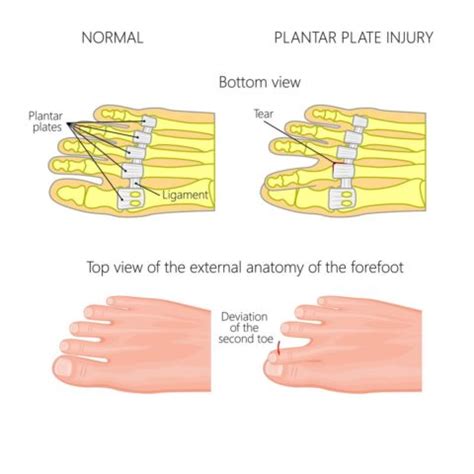 Plantar Plate Repair Surgery | Marietta Foot Doctor | Read More Now!