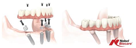 Dental Implant Costs | Smart Dental Implants Center