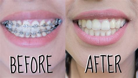 Dental Braces Before and After (New Pictures) | Teeth after braces, After braces, Dental braces