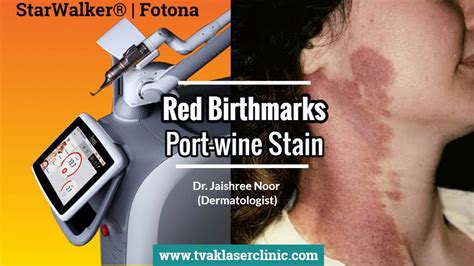 Red Birthmark - Port-Wine Stain Removal in Delhi - Dr. Jaishree Noor ...