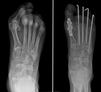 Rheumatoid Arthritis of the Foot and Ankle - OrthoInfo - AAOS