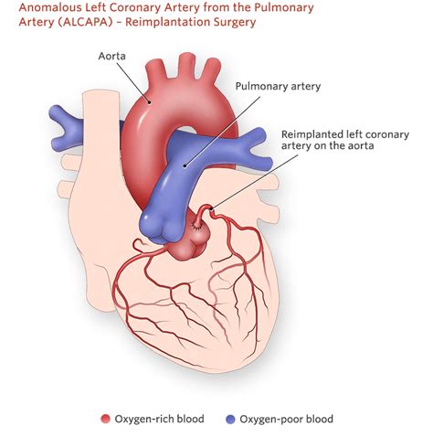 ALCAPA-Reimplmentation Surgery – SujyotHeartClinic