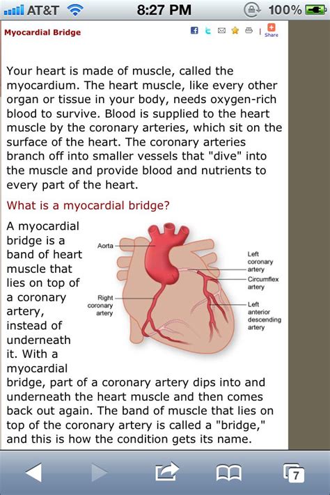 myocardial bridge | Health site, Parts of the heart, Boost metabolism