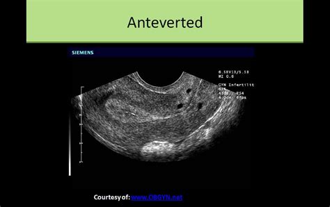 Anteverted Uterus on Ultrasound | Ultrasound, Diagnostic medical sonography student, Medical ...