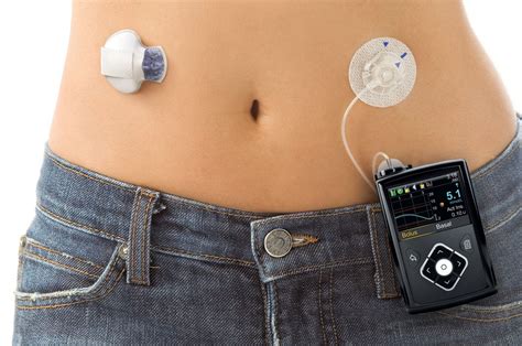 Real-Time Continuous Glucose Monitoring (rtCGM) Improves Glucose Control In Type 1 Diabetes ...