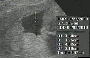 Amniotic Fluid Index (AFI)