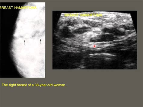 Case 4 Breast Hamartoma - YouTube