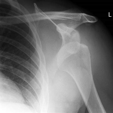 Shoulder Dislocation X Ray