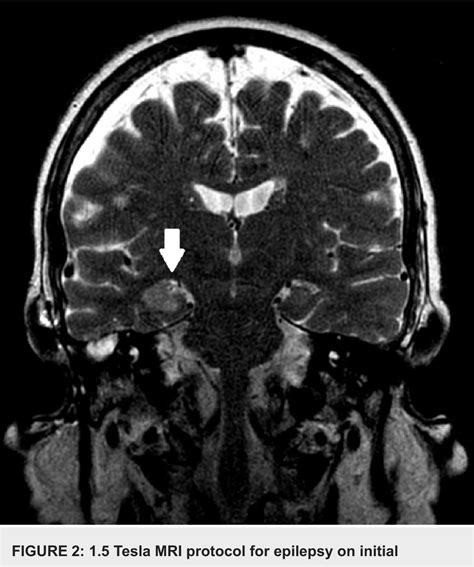 [PDF] A Case of Mesial Temporal Lobe Sclerosis Following Temporal Bone Encephalocele Repair for ...