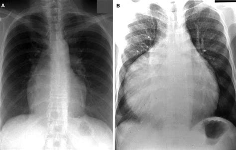 Transposition Of The Great Arteries X Ray