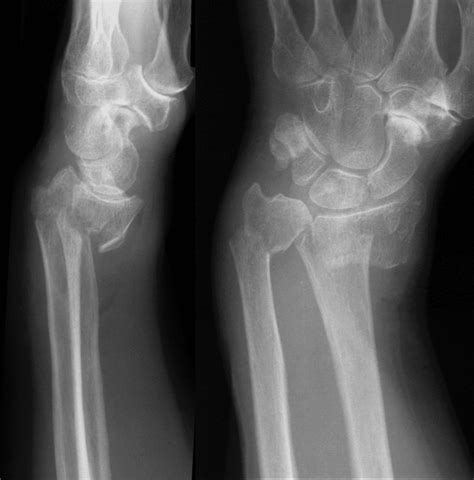 Smith fracture • LITFL • Medical Eponym Library
