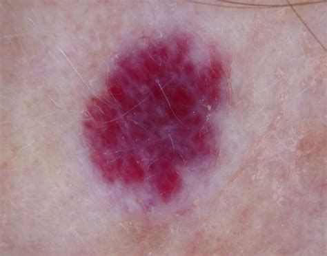 Cherry Angioma - Pictures, Removal, Causes, Home Treatment