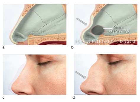 Perforated Septum, Dr. Hamilton - Surgical Repair of a Hole in the Septum