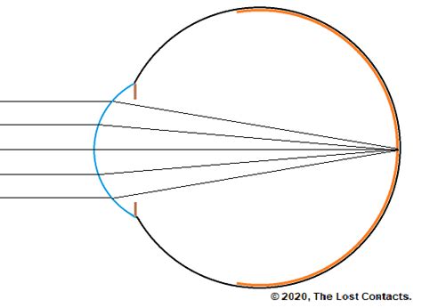 The Optics of Vision - Lesson 6: Emmetropia & Myopia - The Lost Contacts