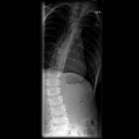 Osteoblastoma - wikidoc