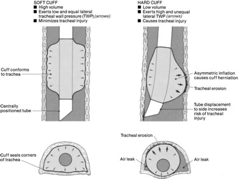 13: Tracheal Tube Cuff Care | Clinical Gate