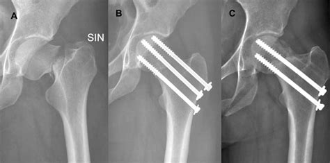 Femoral neck fracture complications - lopigraph