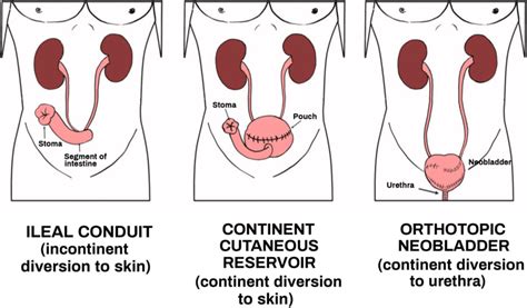 Types of urinary diversions. The three main types of urinary diversions... | Download Scientific ...