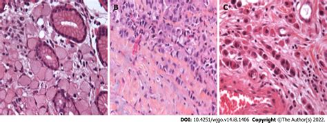 Gubanc Fogalmazza Jelentőségteljes diffuse gastric cancer signet ring ...