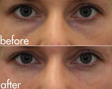 Cannula Tear Trough Filler | Dr. Brett Kotlus, Cosmetic Oculoplastic Surgeon, NYC