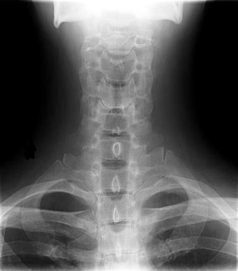 File:Cervical Xray Lower AP View.jpg - Wikimedia Commons