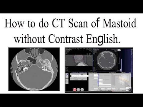 ct mastoid procedure - CT Scan & MRI