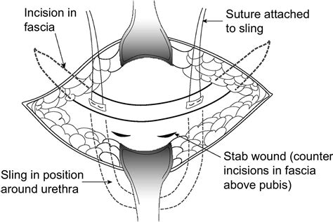 Pubovaginal Fascial Sling for the Treatment of all Types of Stress Urinary Incontinence ...